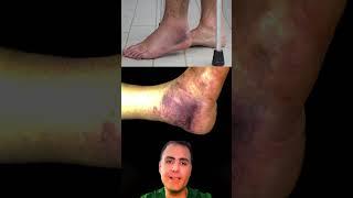 Ankle Fracture