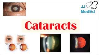 Cataracts | Causes, Risk factors, Subtypes (Cortical, Nuclear, Posterior subcapsular), Treatment