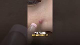 절대 짜면 안되는 여드름이 있다고? #shorts