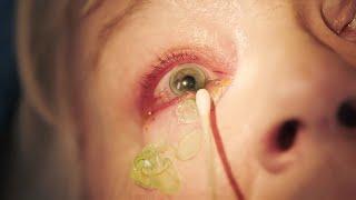 More than a dozen contacts stuck in a woman's eyes