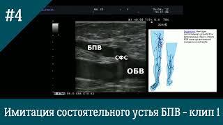 УЗИ вен. Несостоятельность СФС. Имитация состоятельности устья БПВ при пробе Вальсальвы.