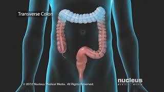 Colon Problems: Diverticular Disease