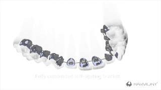 American Orthodontics Harmony Self Ligating Digital Lingual System Aparelho Lingual