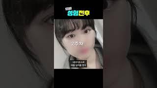 장원영 같은 세미아웃라인 가지고 싶다면 #강남역성형외과 #인스타성형외과 #세미아웃라인 #쌍꺼풀수술후기 #쌍수 #쌍수후기 #쌍꺼풀수술