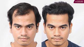 Awestruck Results Of A Hair Transplant | Before After Hair Transformation | Amazing Result