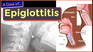 Epiglottitis