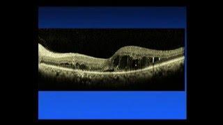 Diabetic Macular Edema - Saving Sight 2014