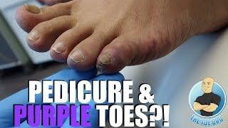 PEDICURE CAUSED PAINFUL PURPLE PINKY TOES?