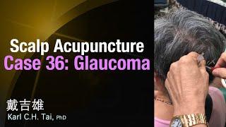 Tai's Scalp Acupuncture - Case 36: Glaucoma