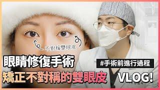 眼睛修復手術 矯正不對稱的雙眼皮! 上｜韓國可優整形外科&皮膚管理