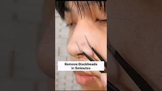 Remove Blackheads & Whiteheads In 5 minutes #shorts #skincare