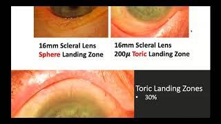 Scleral Lens Fitting Challenges 10/27/20