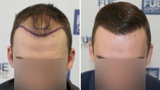 FUE Hair Transplant (2700 Grafts in NW-Class lll-A) Dr. Juan Couto - FUEXPERT CLINIC- Madrid, Spain