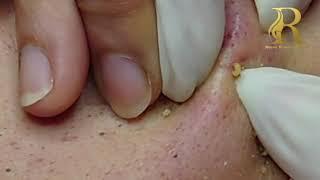 洛莎皮膚管理中心-여드름추출 深層祛痘技術(清粉刺) | Big Blackheads Extraction