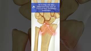 Understand Wrist Fractures - 3D Animation  #wristfracture #wristpain #wristinjury