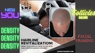 Scalp Micropigmentation at SMP of Lexington (Kentucky)