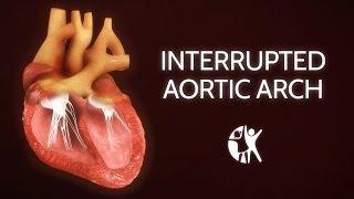 Interrupted Aortic Arch − Ventricular Septic Defect