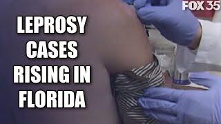 Leprosy cases rising in Central Florida