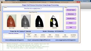 Finger Nail Disease Detection using Image Processing Matlab Project with Source Code