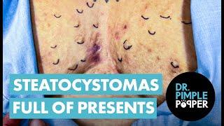 Steatocystomas Full of Presents