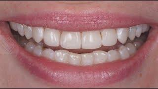 Композитные виниры. Composite veneers. Виниры до и после