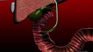 Biliary Drainage  Catheter insertion animation