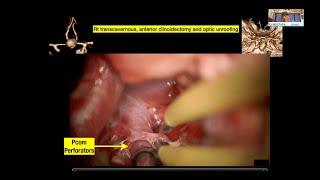  Microsurgical Obliteration of 12 mm Anterior Communicating Artery and 7 mm Basilar Tip Aneurysms