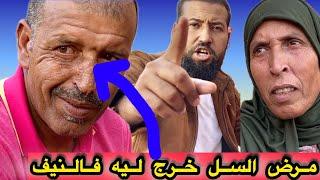 هادشي كامل لي وقع بسباب  المرض ديال السل 🫢🫢 لي خرج ليه في الأنف ديالو