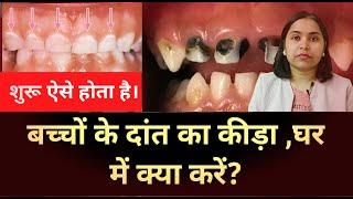 बच्चों के दांत का कीड़ा। घर में क्या करें। Dental caries in kids । Tooth cavity । Dental