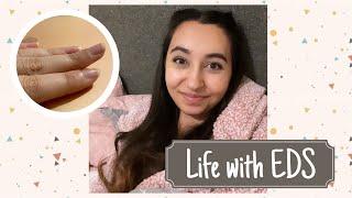 Living with EDS | Being Sick in Public & Subluxations!