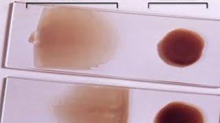 how to make blood slide smear|| blood film || thin blood smear||