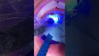 Anterior Bite Turbos - Tooth Time Family Dentistry New Braunfels Texas