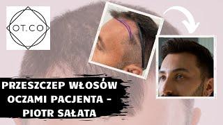 Przeszczep włosów oczami pacjenta - Piotra Sałaty - OT.CO Clinic