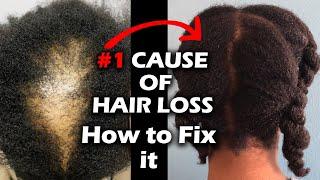 This is the #1 CAUSE OF HAIR LOSS! HERE IS HOW TO FIX #alopecia