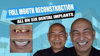 New Teeth, New Smile: Watch Our Patient's Dental Transformation  | Interview for new teeth