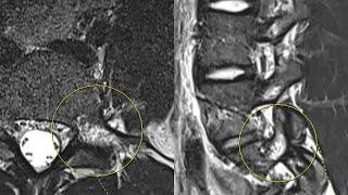 Pars Stress Reaction with Dr. Giuffrida