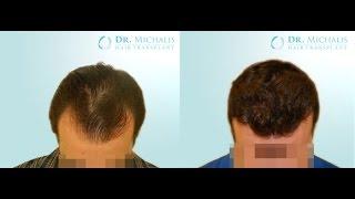 2800 Grafts full shave FUE Hair Transplant - Dr. Michalis