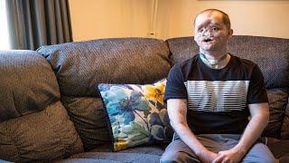 Michigan man seeking face transplant shares his story