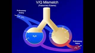 Hypoxia and Hypoxemia: Mechanisms and Etiologies (ABG Interpretation - Lesson 18)