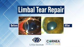 Limbal tear Repair | Cornea Colours | Season 2