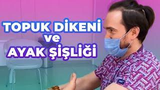 Ayakta şişlik, Topuk Dikeni - Bülent Aydın