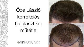 Őze László korrekciós hajplasztikai műtétje