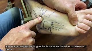 Topographical Anatomy of the Foot and Ankle  Lateral Aspect and Nerves of the Foot and Ankle