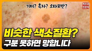 이게 다 같은 색소질환이 아닙니다!! #기미 #흑자 #오타모반 #피부과전문의