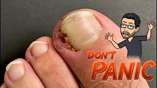 CATASTROPHIC INGROWN TOENAIL