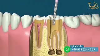 فيديو علاج العصب الاسنان و حشو الجذور الاسنان | طب الاسنان في ايران  |  طب توب