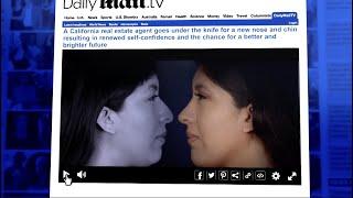 Dr. Rady Rahban on Daily Mail TV - Rhinoplasty w/ Chin Augmentation