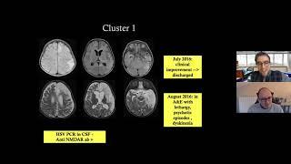 Unusual cases of immuno-mediated encephalitis: PediNeurorad cafe' with Drs D'Arco & D'Anna