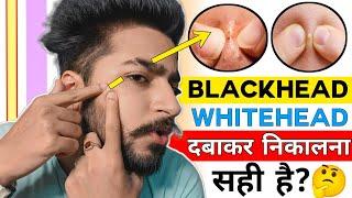 Blackhead, Whitehead को दबाकर निकालना सही है ? | Blackheads Popping Side Effects