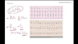 LVH on ECG (Left ventricular hypertrophy) - Learn ECG! - Dr Jamal USMLE